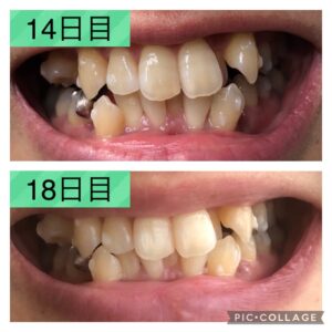 歯並び比較14-18