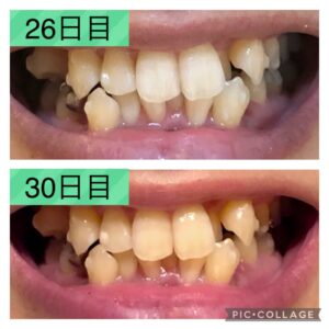 歯並び26-30