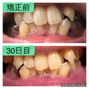 歯並びbefoer-30