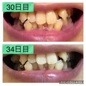 歯並び30-34