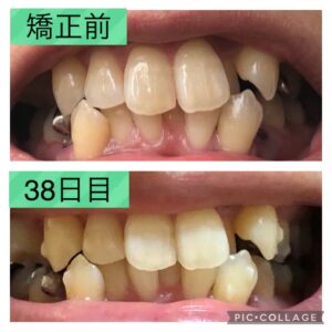 歯並びbefoer-38