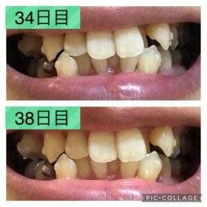 歯並び34-38