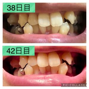 歯並び38-42