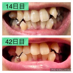 歯並び14-42