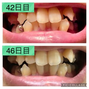 歯並び42-46